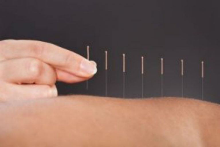Alleviate Pain with Cupping Therapy in Los Angeles