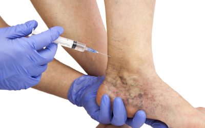 Find Relief at Varicose Vein Center Chicago IL: Expert Treatments Await